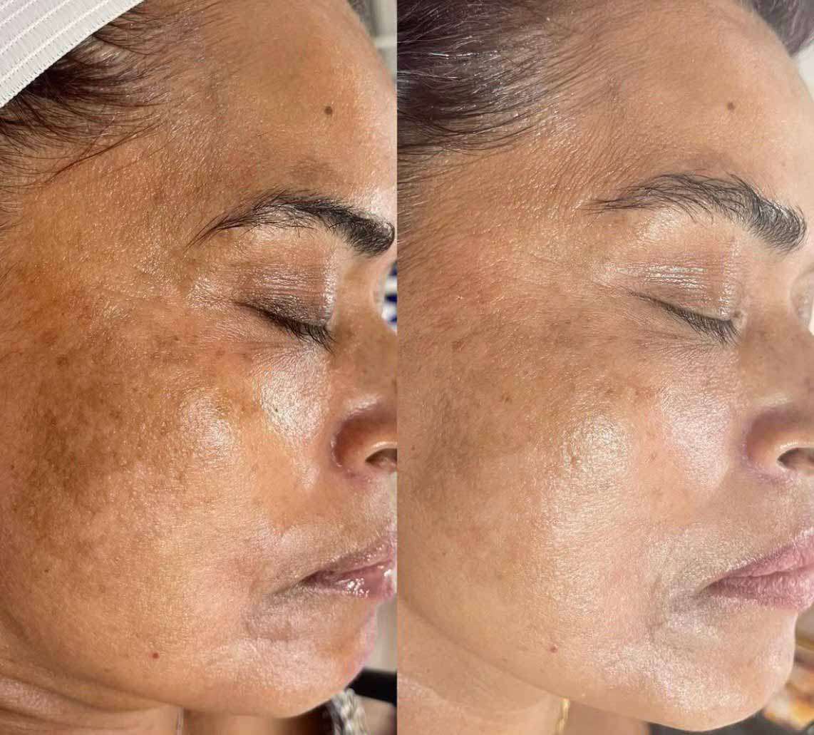 Laser Hyperpigmentation Treatment – AveenaCosmetic